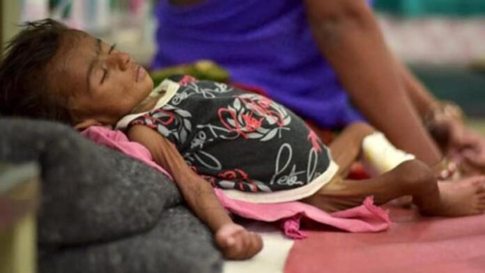 Child Malnutrition Child Malnutrition